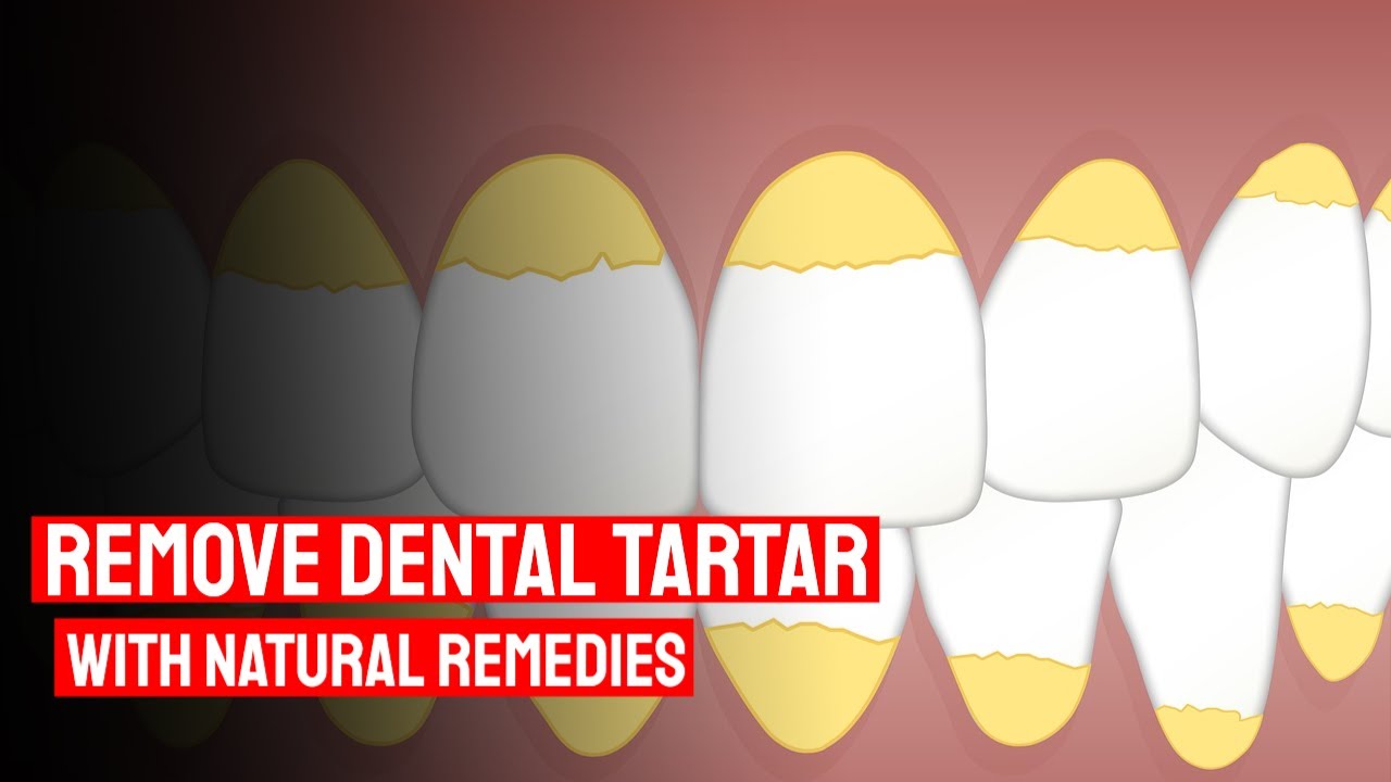 Remove Dental Tartar With Natural Remedies