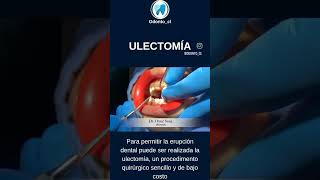 #ulectomia #odontologia #dentista #cirujanodentista