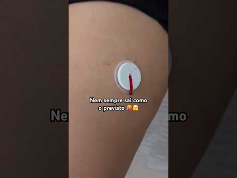 Aplicando o sensor FreeStyle Libre. Dessa vez… 🥵😢 #shorts #glicemia #sensor #dm1 #dexcom
