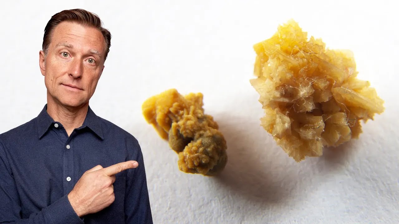 The Deeper Cause of Kidney Stones You’ve Never Heard About
