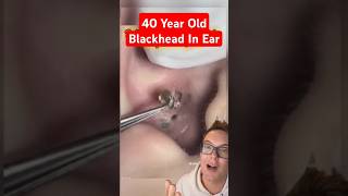 OMG 40 Year Old HIDDEN BLACKHEAD REMOVAL #shorts