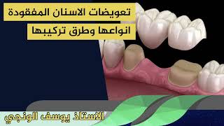 تعويضات الاسنان المفقودة انواعها وطرق تركيبها الاستاذ يوسف الونجي
