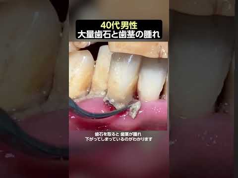 早期治療で歯を残しましょう‼️【歯石除去】 #ザホワイトデンタルクリニック #歯医者 #歯石除去 #歯周病 歯周病