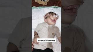 Anencefalia