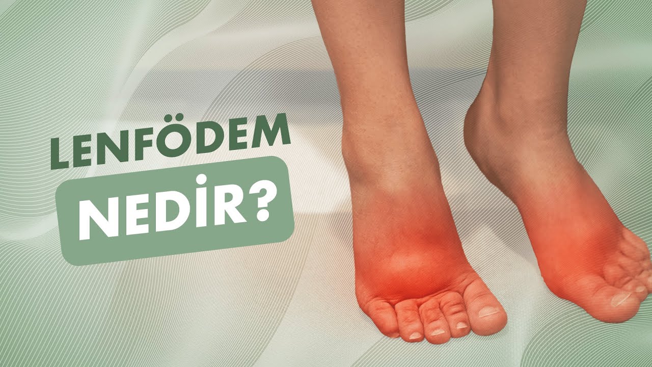 Lenfödem Nedir?