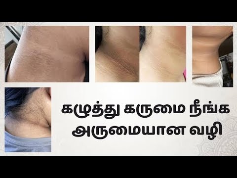 கழுத்து கருமையை எளிமையாக அகற்றலாம் / Tips to remove black neck pigmentation