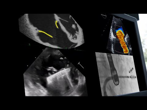 How to identify patients for tricuspid interventions – Webinar