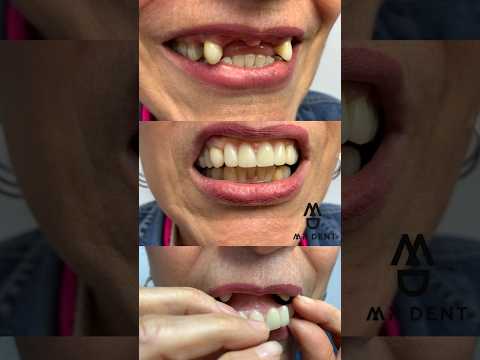 ESTA  PRÓTESIS ES MÁS CÓMODA #viral #odontologia #misterdent