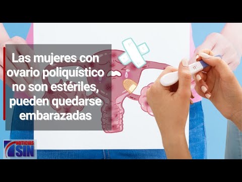 ¿Se puede quedar embarazada con ovario poliquístico?