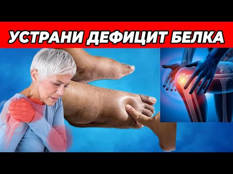 15 Сигналов Дефицита Белка: Как Это Влияет На Ваше Здоровье?