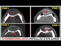 Understanding Condromalacia Stages and Treatments