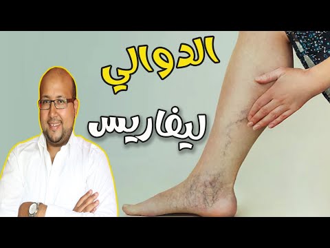 الأوردة العتكبوتية أو الدوالي  مع الدكتور عماد ميزاب