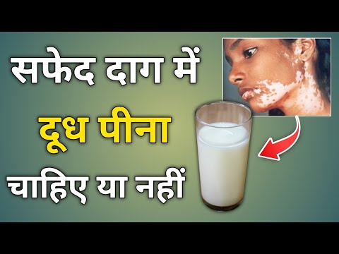 सफेद दाग में दूध पीना चाहिए या नहीं | safed daag me dudh pina chahiye ya nahi