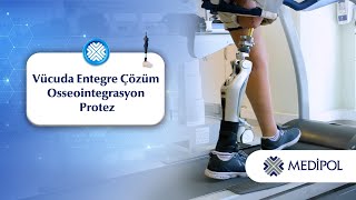 Gelişmiş Protez Tedavisi: Osseointegrasyon ile Daha Konforlu Bir Yürüyüş