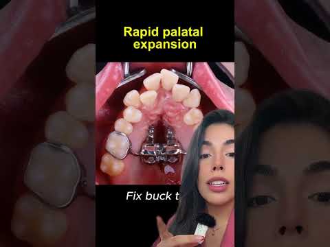 Paladar OJIVAL #shorts