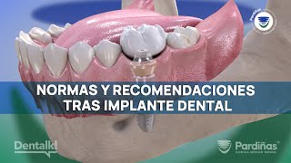 ¿Te han colocado un IMPLANTE dental? QUÉ HACER y QUÉ NO para recuperarte bien y que dure ©