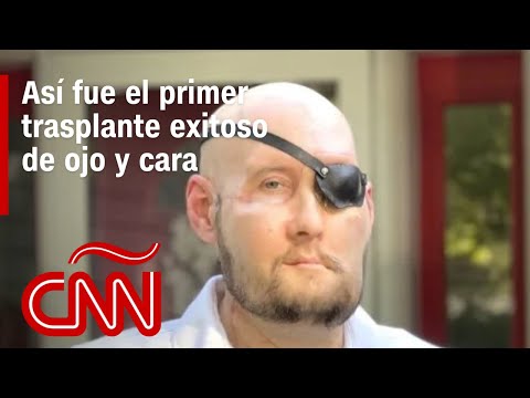 El Dr. Huerta explica cómo se hizo el primer trasplante de ojo y cara ...