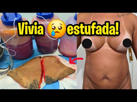 MÃE 4 FILHOS TRANSFORMA ABDÔMEN! TIROU 0,5KG NA ABDOMINOPLASTIA!! Dr Valter Hugo