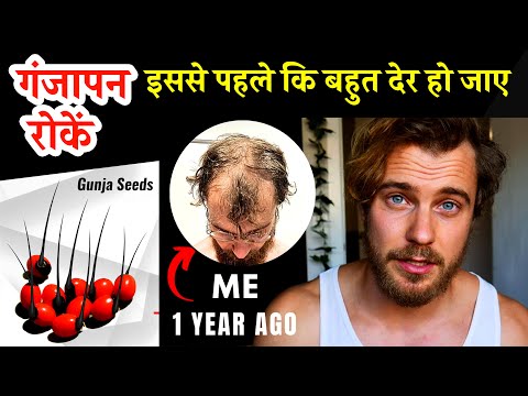 गंजापन रोकें: इससे पहले कि बहुत देर हो जाए । Preventing Balding | gunja oil benefits