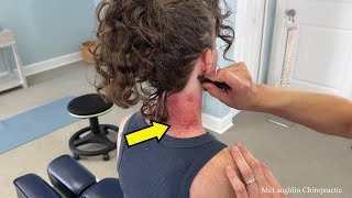 It's Unbelievable...PURPLE Marks Pour Out Of Her Neck! Tech Neck & Jaw Pain Get HELP! Sooo CRUNCHY