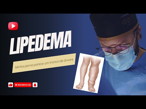 Desvendando o Lipedema: Entenda Sintomas, Diagnóstico e Tratamento | Conscientização