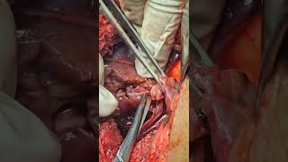 Nephrone sparing surgery of right endophytic 3x2 cm solid renal tumor T1sNoMo by Dr.liaqat Ali ikd