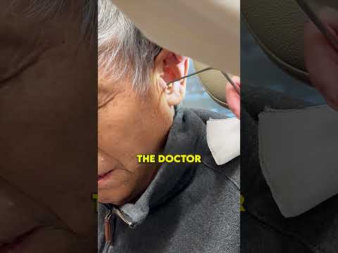 Doctor Pulls Out MASSIVE Earwax From His Ears! 🤯