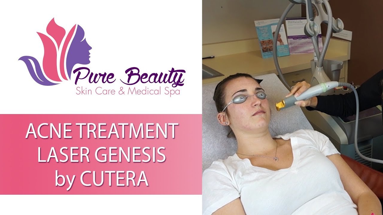 Laser acne treatment at Pure Beauty Spa