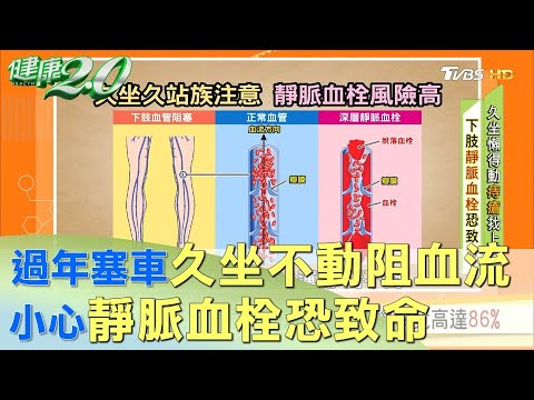 過年塞車久坐不動阻血流 小心靜脈血栓恐致命 健康2.0