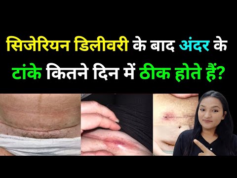 Cesarean Delivery के बाद अंदर के टांके कितने दिन में ठीक होते है? cesarean Delivery Recovery Time