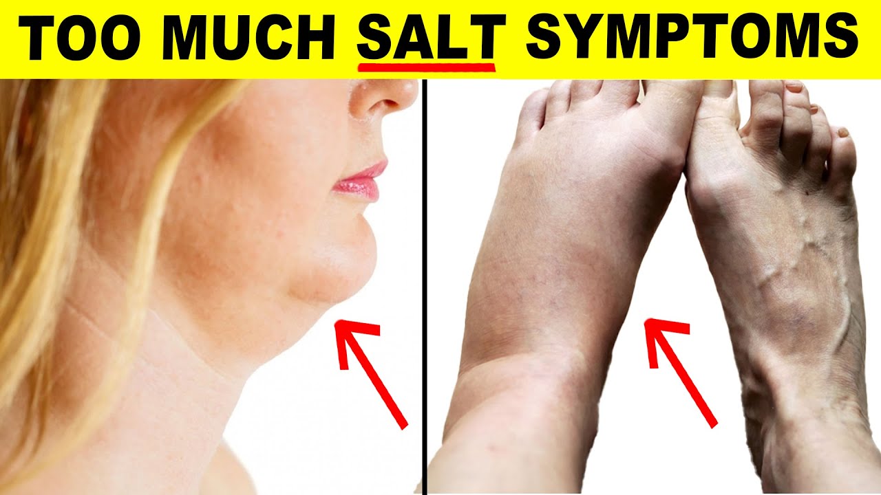 9 Signs You’re Eating Too Much Salt