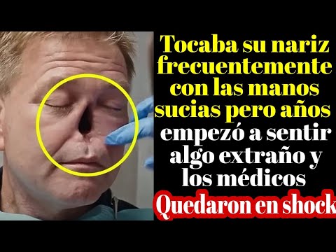 Se Quedó Sin Nariz! 😱 Tocaba su nariz con las manos sucias y esto fue lo que sucedió.