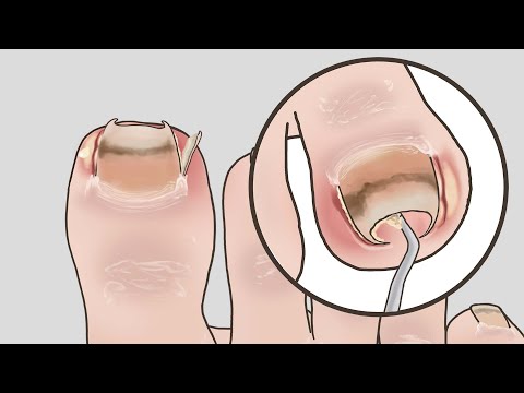 ASMR 내성발톱케어 3탄 Ingrown toenail removal