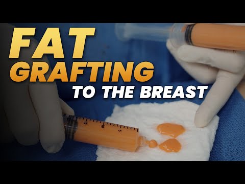 Fat Grafting to the Breast