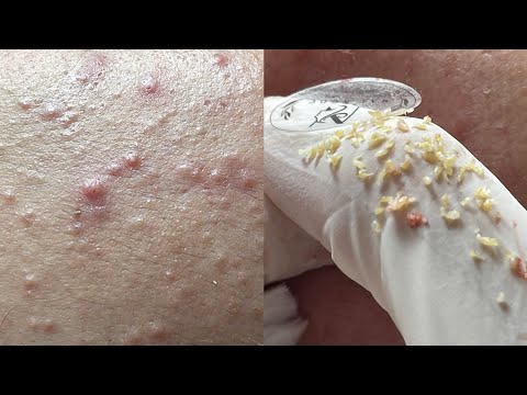 All the pimples on face on gloves - Acnes Treatments Mai Ngoc 💕💕💕