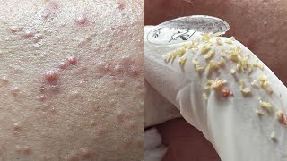 All the pimples on face on gloves - Acnes Treatments Mai Ngoc 💕💕💕