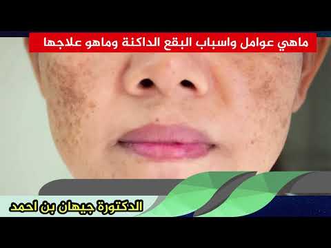 ماهي عوامل واسباب البقع الداكنة وماهو علاجها الدكتورة جيهان بن احمد