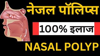 नाक में गाँठ का होम्योपैथिक इलाज || Homeopathic Treatment For Nasal Polyps
