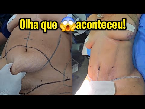 TRANSFORMAÇÃO INCRÍVEL COM ABDOMINOPLASTIA: OLHA RESULTADO DESSA MAMÃE 44 ANOS!!