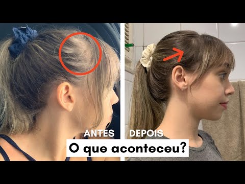 QUEDA DE CABELO:  MEU RELATO, CAUSAS, TRATAMENTO, MINOXIDIL