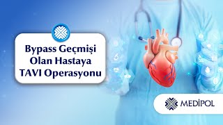 Aort Kapak Darlığı Tedavisinde TAVI Operasyonu