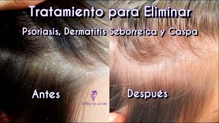 ¿Cómo eliminar la caspa y dermatitis seborreica en casa fácil?