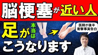 【放置禁止】脳梗塞が近い人に起こる５つの「足の異変」　見逃すとどうなるかと予防も医師が解説