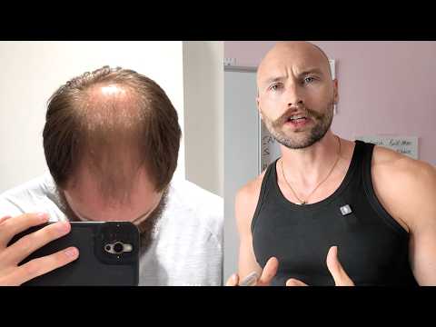 Still Hiding Your Balding? This ONE THING Will Set You Free