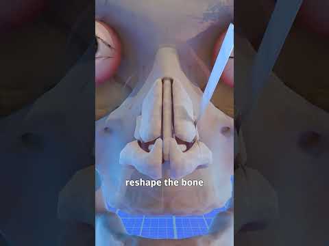 How A Nose Surgery Works ๐ค