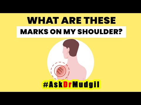 WHAT ARE THESE MARKS ON MY SHOULDER?