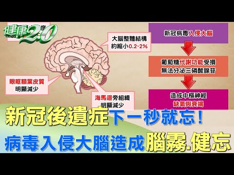 下一秒就忘！ 新冠後遺症25%出現腦霧會健忘 健康2.0