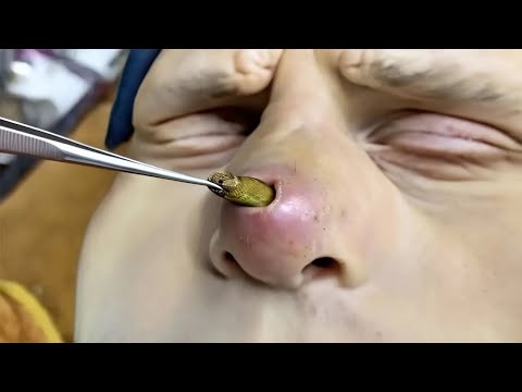 he said something was in his nose..