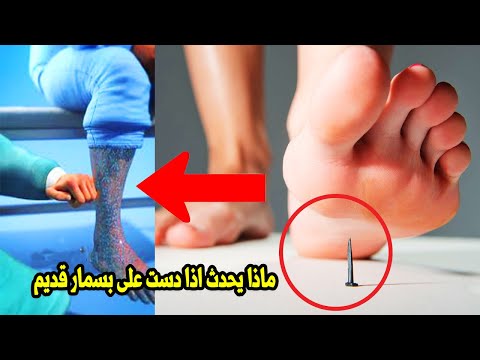 ماذا يحدث للجسم اذا دست على بسمار قديم احذر؟مرض الكزاز؟