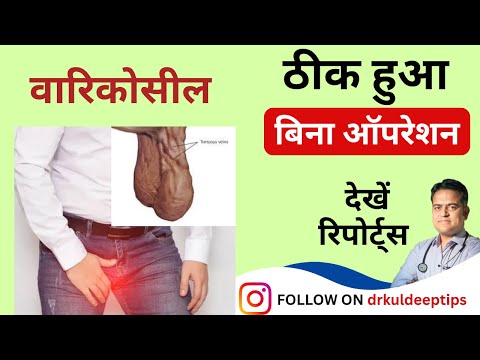 वारिकोसील का बिना ऑपरेशन इलाज । Varicocele ka bina operation ilaj ।